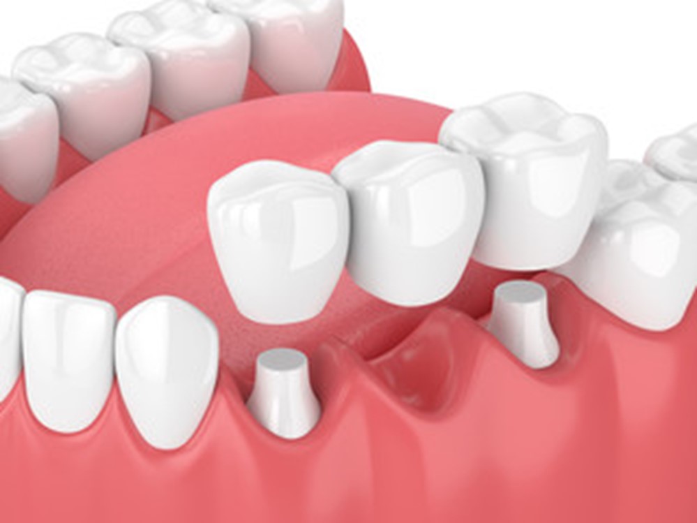 Illustration of dental bridge being placed.