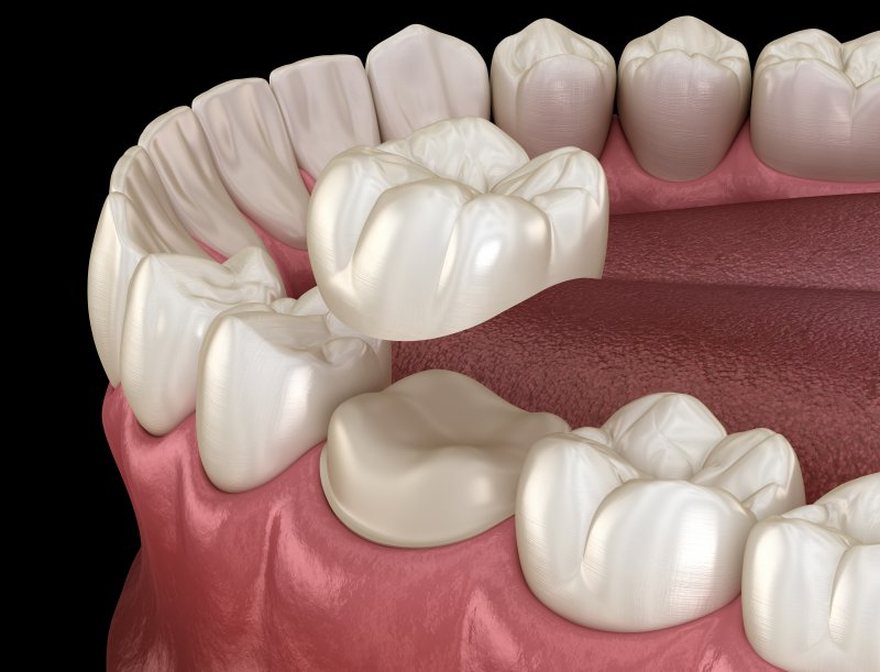 3D illustration of a dental crown