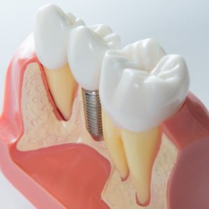 Model of single dental implant