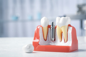 Model of a dental implant post between two teeth