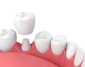 Dental crown being attached to a prepared tooth 