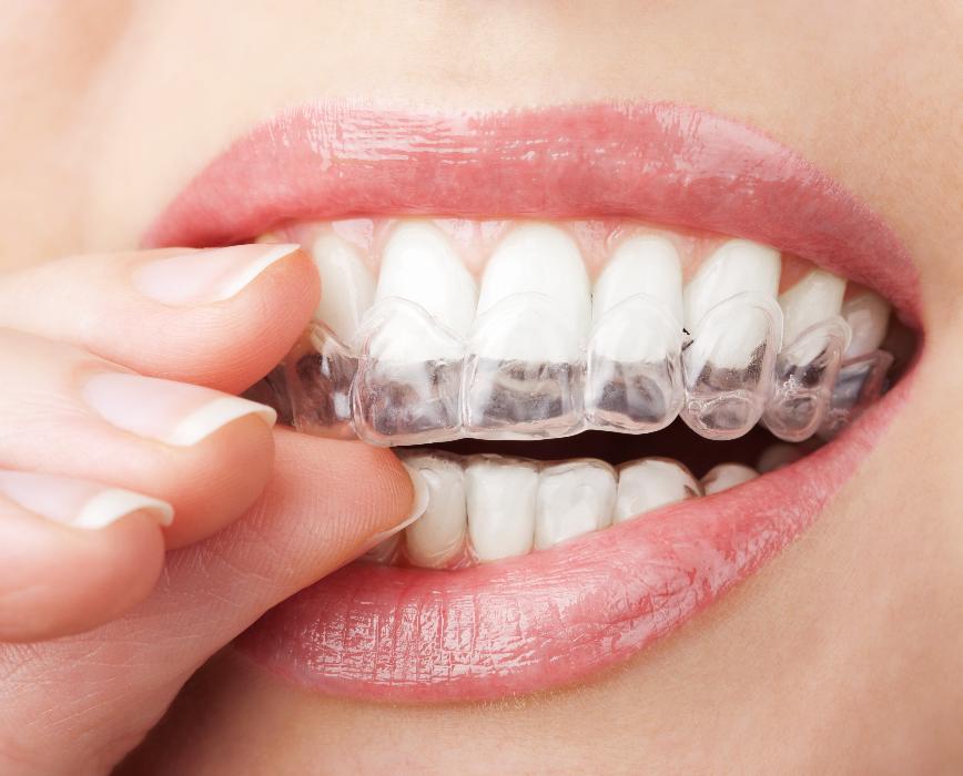 patient putting in invisalign | invisalign cary nc