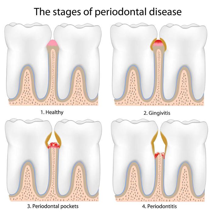 image of periodontal pockets | gum disease cary