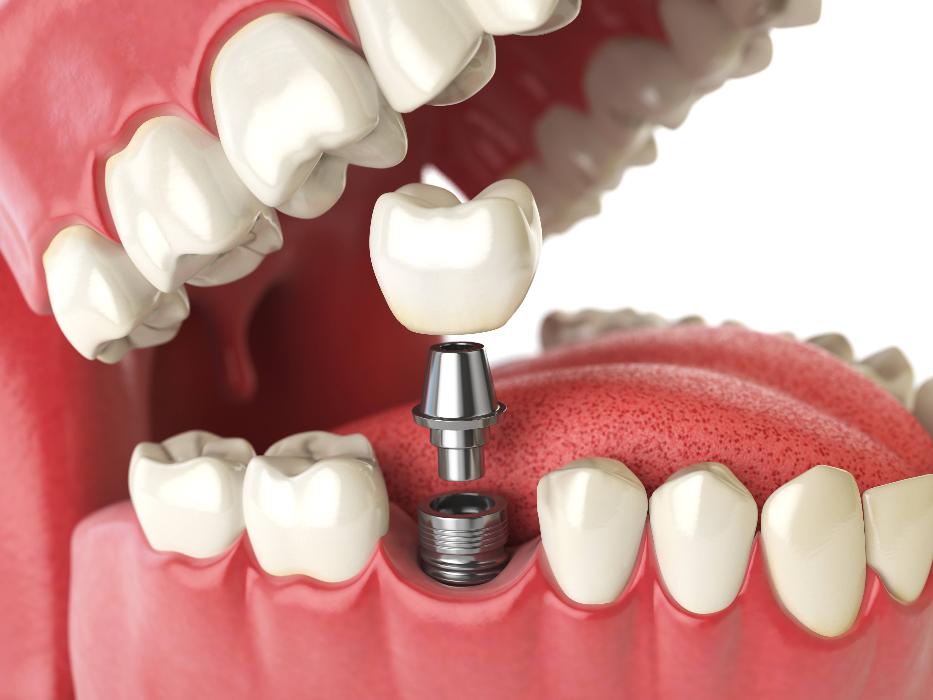 tooth implant in lower jaw | dental implants cary nc