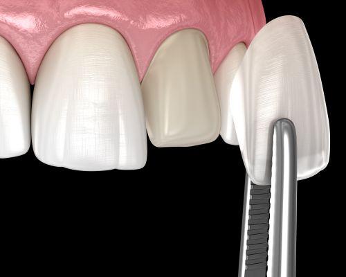 veneer being places on tooth | veneers cary nc