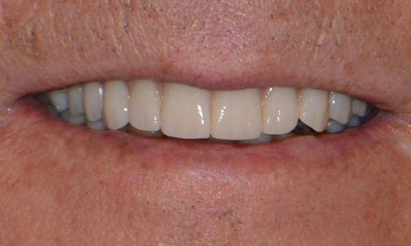 After photo of a fixed hybrid zirconia bridge on dental implants in Cary, NC