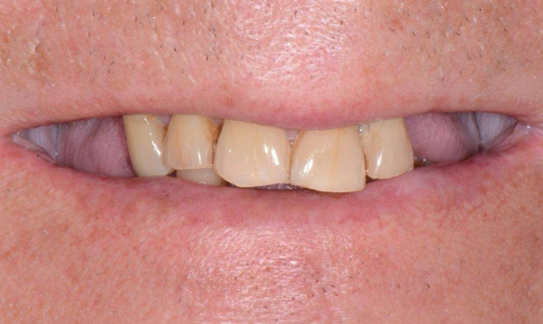 Before photo of a loose upper partial denture and missing back teeth in Cary, NC