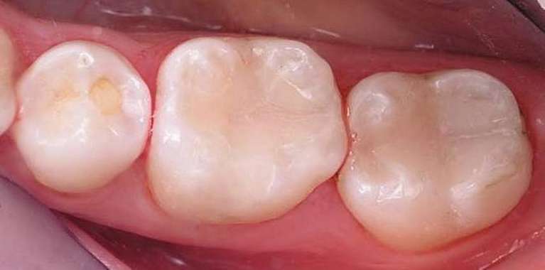Composite-Resins-Restoring-Decayed-Teeth-After-Image