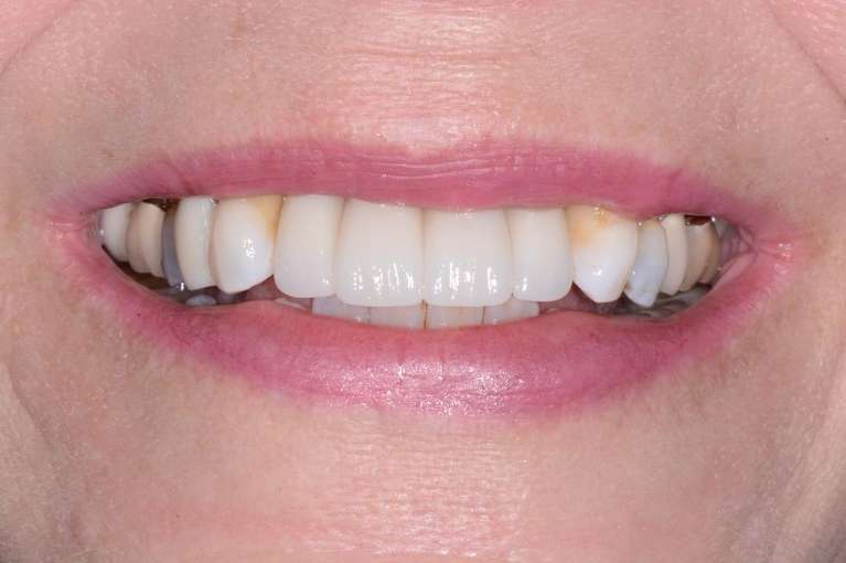 Porcelain-Bridge-on-2-Implants-After-Image