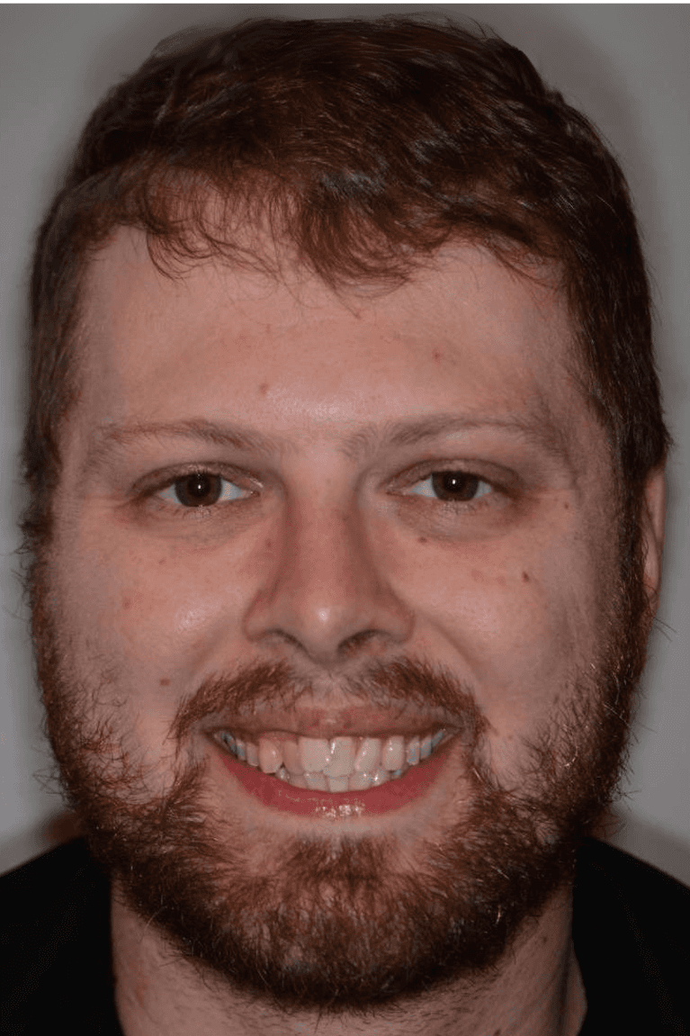 Invisalign-Teeth-Whitening-Before-Image
