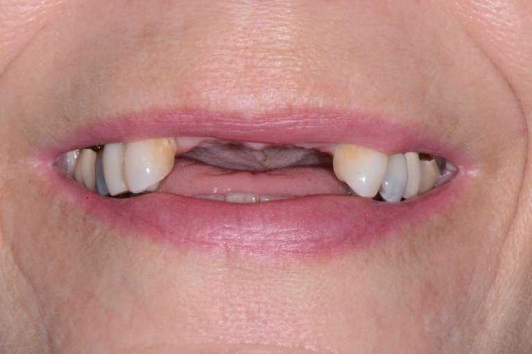 Porcelain-Bridge-on-2-Implants-Before-Image